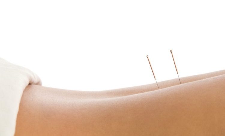 The Acupuncture Evidence Project