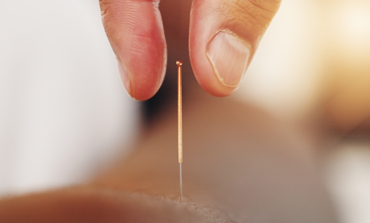 Acupunctuur bij pijnlijke diabetische perifere neuropathie